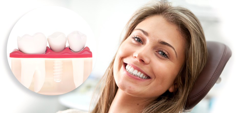 Dental Implants